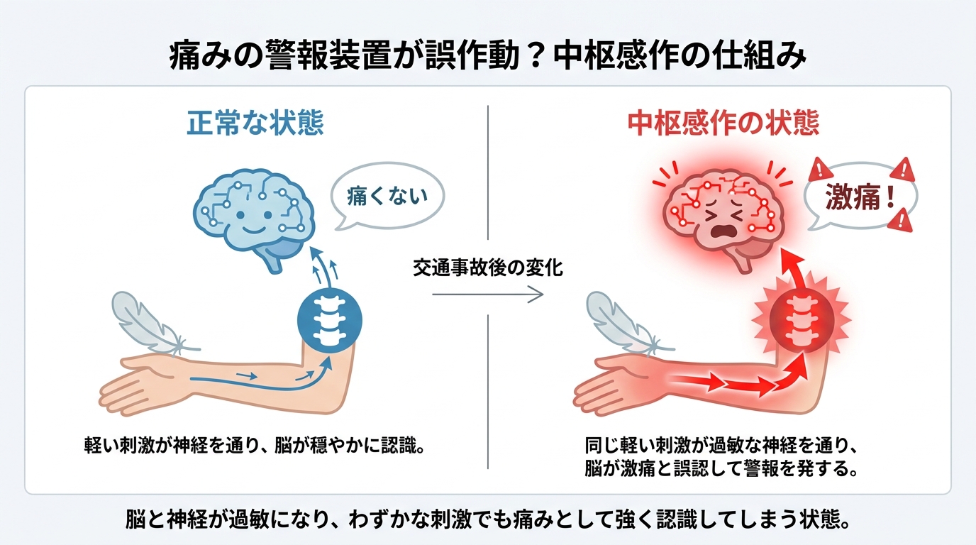交通事故後の慢性痛の原因となる「中枢感作」のメカニズムを図解。正常時と感作時で、同じ刺激に対する脳の反応が全く異なることを比較している。